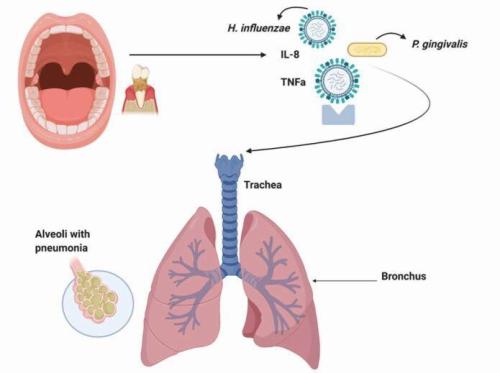 diagram illustrating how bacteria from the oral cavity and inflammatory cytokines have affected the lungs