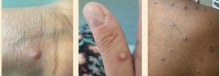 MPX Lesions image of MPX lesions