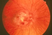 Retinitis -- a red circle with visible lines
